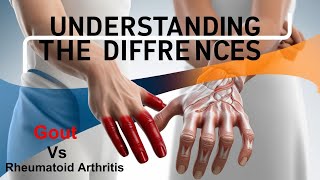 Gout Vs Rheumatoid Arthritis Understanding the Differences [upl. by Allebram]