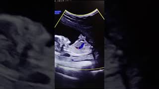 Gastroschisis video ultrasound viral baby pregnant video week spregnant [upl. by Bridge80]