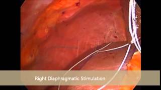 Diaphragmatic Pacer in an ALS Patient [upl. by Kahlil123]