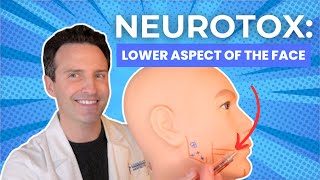 Neurotoxins Lower Aspect of the Face [upl. by Aural]