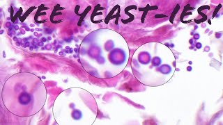 Yeast Skin Fungus MalasseziaPityrosporum incidental in actinic keratosis  not yeast infection [upl. by Trillbee]