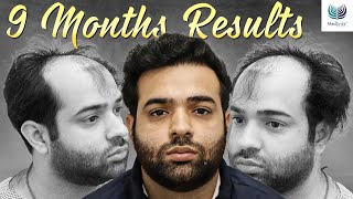 JawDropping 9Month Hair Transplant Transformation  Medlinks Hair Transplant Delhi [upl. by Dimitri]