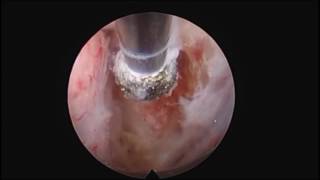 C12 Rheumatoid Pannus arthritis endoscopic decompression [upl. by Chavez]