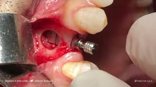 IMPLANTOLOGY  REX CASE REPORT Implant in thin crest  Dr Alberto Rebaudi [upl. by Kissel]