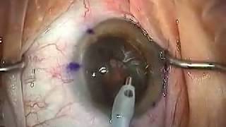 Modern Cataract Surgery Alcon ReSTOR IOL with LRI [upl. by Itraa]