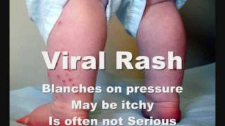 How To Check Meningitis Rash [upl. by Zennas]