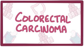 Colorectal carcinoma  causes symptoms diagnosis treatment pathology [upl. by Annaej]