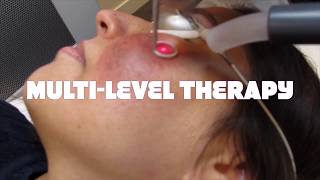 Treatment of dermal melasma using the picoway laser The Spinning Wheel Method by Dr David Njoo [upl. by Rivard82]