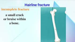 Types Of Fractures  Bone  Orthopedic  orthopedics ms fcps doctor fracture [upl. by Aileve]