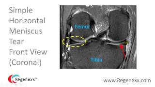 How to Read a Knee MRI for Meniscus Tears [upl. by Leonerd]