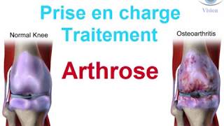 Traitement de lArthrose douleur cervicale du genou How to treat osteoarthritis [upl. by Kenric438]