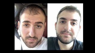 Hair Growth Results ll Before and After ll How I Did It [upl. by Aniez]