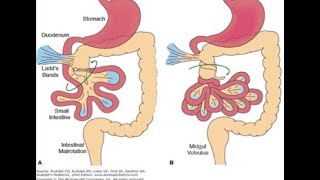 pediatric surgery GI disorders meconium ileus midgut malrotation د عامر الخزاعي [upl. by Ferneau]