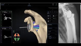 ScapuloThoracic Orientation during PreOp planning in Reverse Shoulder Arthroplasty [upl. by Verdha393]