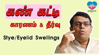 கண்கட்டி  காரணம் amp தீர்வு Stye  Eyelid Swellings  தமிழ் [upl. by Ahsekal486]