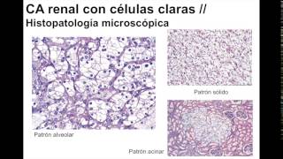 Carcinoma de células renales [upl. by Cohlette]