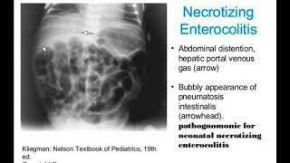 Necrotizing enterocolitis2 [upl. by Sewole882]