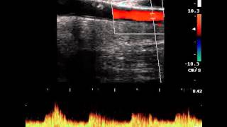 ANONYMOUS TRUNK STENOSIS [upl. by Holub]