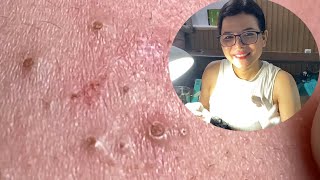 Acne Treatment Huong Da Nang573  2023 [upl. by Atenahs676]