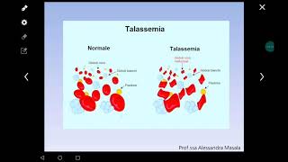 Le malattie genetiche a trasmissione mendeliana parte 1 [upl. by Ahsilac]