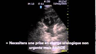 Uretero Hydronephrose moderee Echographe de poche Vscan utile en urologie aux urgences [upl. by Arihat]