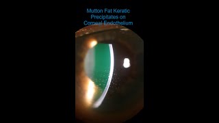 Intermediate Uveitis  Vitritis amp Mutton Fat KPs [upl. by Hannahoj729]