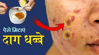 pimples ke daag dhabbe thik karne ke upay [upl. by Petigny250]