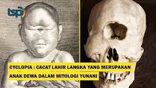 ENG SUB Cyclopia A rare birth defect similar to the Children of Gods in Greek Mythology [upl. by Nuyh607]