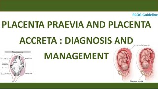 Diagnosis and Management of Placenta Praevia and Placenta Accreta RCOG Guideline [upl. by Livvyy]