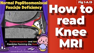 Fig 1A13 normal popliteomeniscal fascicle deficiency [upl. by Trstram696]