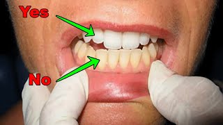 Brushing Your Teeth with Baking Soda Is it Safe or Not [upl. by Shani]