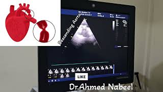 coarctation of Aorta 20 yrs old male missed and treated as a case of HTN 😱🙄 echocardiogram cardio [upl. by Eedak]