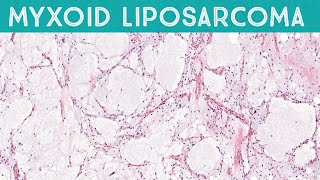 Myxoid liposarcoma high grade formerly round cell liposarcoma AIP France 2021 [upl. by Roice655]