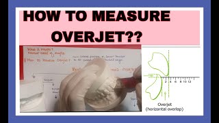 How to measure overjetproffit chapter 1 [upl. by Alderson375]