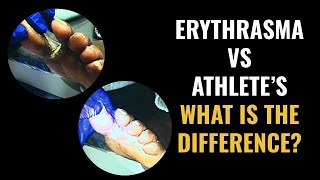 Erythrasma vs Athletes Foot  What is the difference [upl. by Frick485]