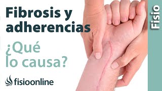 Fibrosis y adherencias  ¿Qué es y cuáles son sus causas [upl. by Arramat]