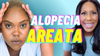 What is ALOPECIA AREATA What Are the Treatments for Alopecia Areata Doctor Explains Photos [upl. by Vanhook529]