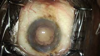 Intumescent cataract Surprise vitreous in AC at the beginning [upl. by Ruby841]