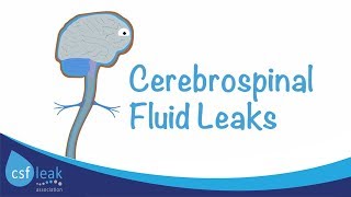 An Introduction to Cerebrospinal Fluid CSF Leaks [upl. by Ellevehc]