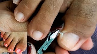 Satisfying Ingrown Toenail Removal  Dry Skin  Pedicure 119 [upl. by Katherine]