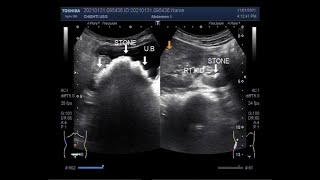 A Large vesical stone two cases [upl. by Oicam]