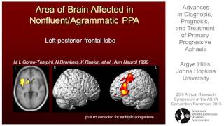 Argye Hillis Advances in Diagnosis Prognosis and Treatment of Primary Progressive Aphasia [upl. by Lamraj]