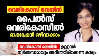 വെരികോസ് വെയിൻ പൈൽസ് വെരികോസീൽ ഓപ്പറേഷൻ ഒഴിവാക്കാം Varicose Vein Piles Varicocele Avoid Surgery [upl. by Jelle]