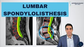 Lumbar Spondylolisthesis  Anatomy Symptoms Causes Treatments and more [upl. by Nerra]