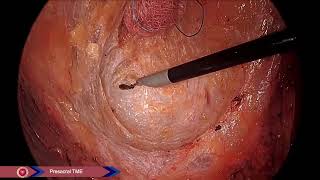 Distal Mucosal margin Tattooing for rectal cancer [upl. by Mcfadden648]