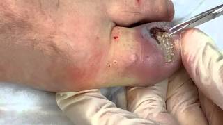 Dystrophic Ingrown Toenail [upl. by Lorianna]