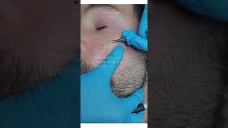 Removal Sebaceous hyperplasia from face using LamProbe [upl. by Aimas]