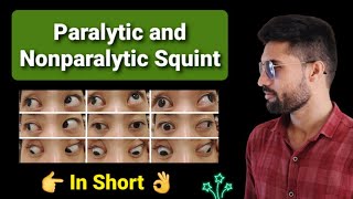 Paralytic vs Nonparalytic Squint lecture opthalmology [upl. by Lenno457]