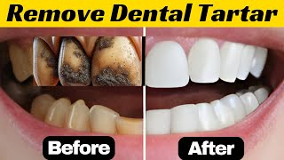 7 Effective Natural Methods to Remove Plaque and Tartar [upl. by Seagrave293]