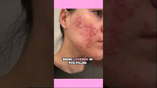 Did I Have Scar Treatments Post Accutane 👀 acne acnescars accutane [upl. by Atiekal]